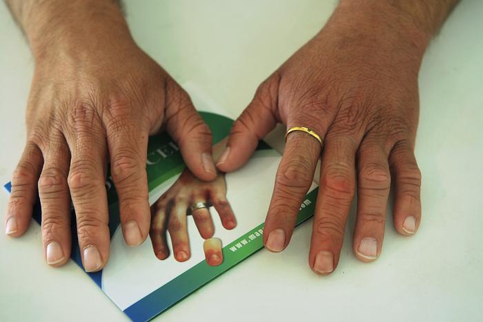 Prosthetic finger